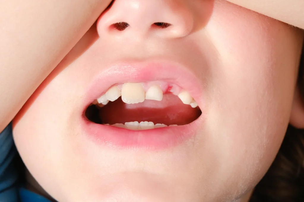 Gestione dei traumi dentali